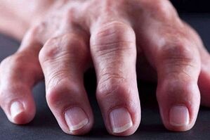 Les principales différences d'arthrite et d'arthrose