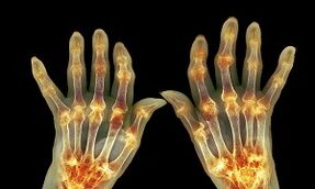 Quelle est la différence entre l'arthrite de l'arthrose des articulations