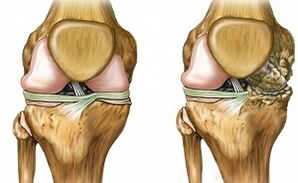 Signes distinctifs d'arthrose articulaire